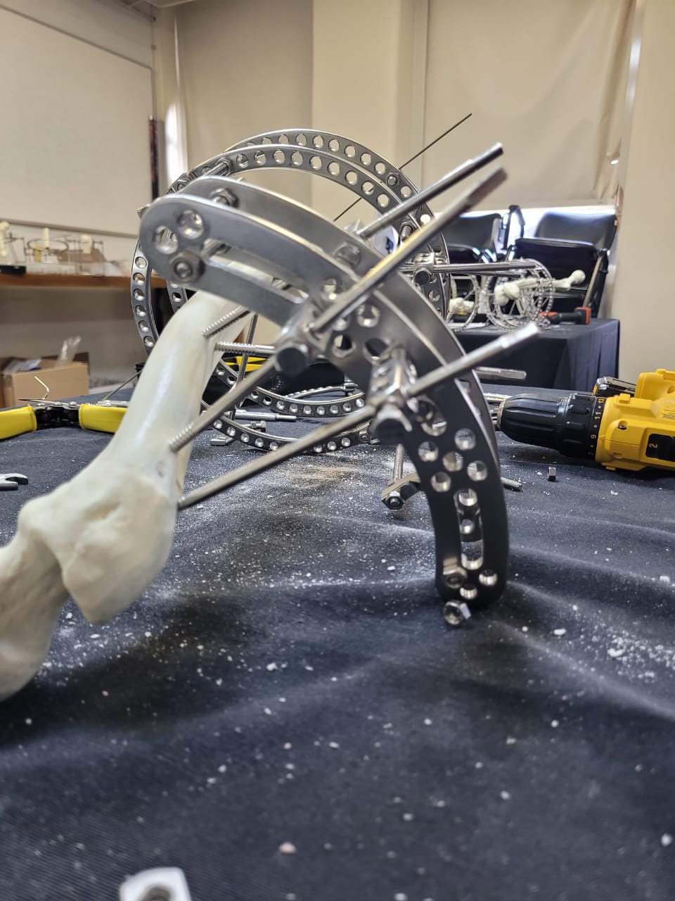 Planejamento e Correção de Deformidades do membro Inferior com Ilizarov Simples e Complexas